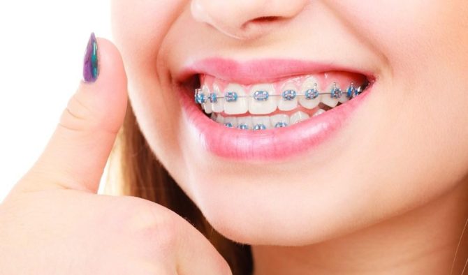 Traitement orthodontique de la parodontite