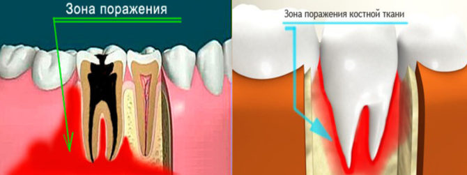 Jaw osteomyelitis