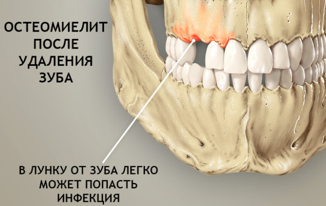 Jaw osteomyelitis