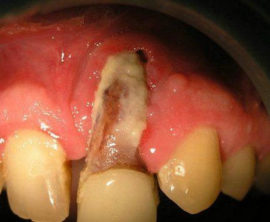 Jaw osteomyelitis