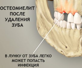 Osteomyelitida po extrakci zubu