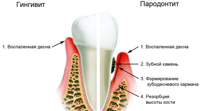 Rozdíly mezi gingivitidou a parodontitidou