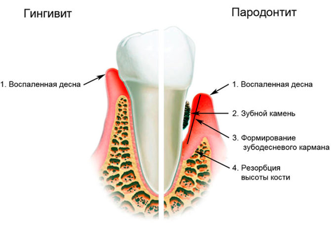Rozdíly v příznakech gingivitidy a paradentózy