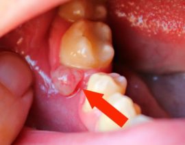 Periodontal abscess