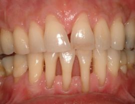 Periodontitis