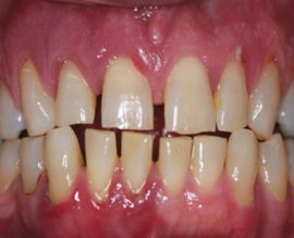 Periodontitis