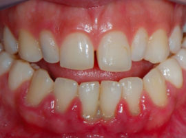 Periodontitis