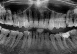 Ang Periodontitis sa larawan