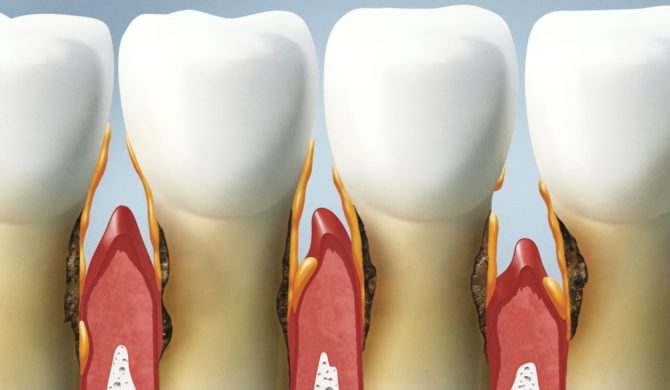 Periodontitis