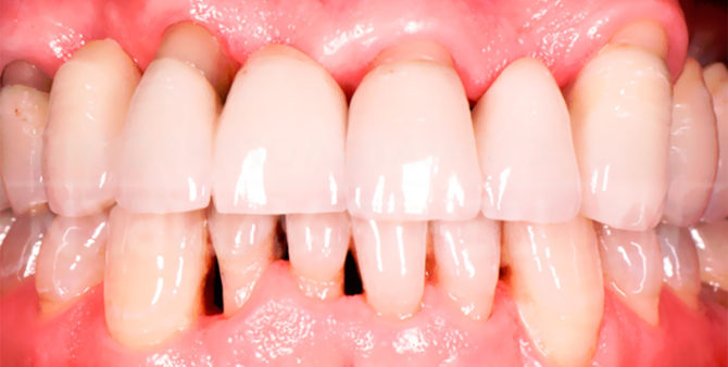 Periodontal disease