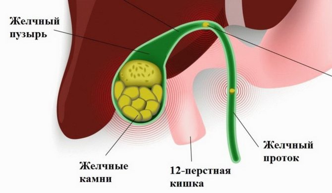 Pathologie des voies biliaires