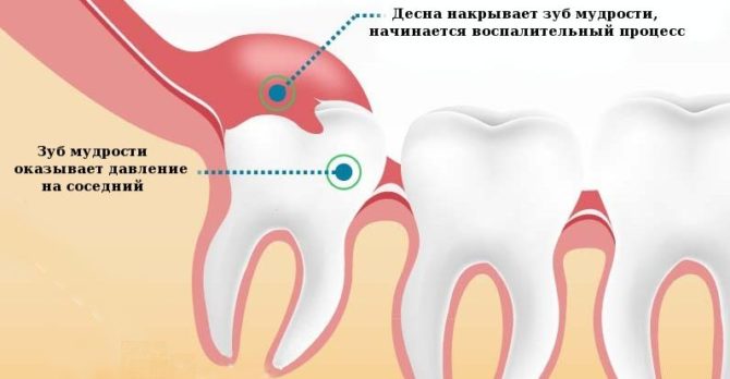 Pericoronitis