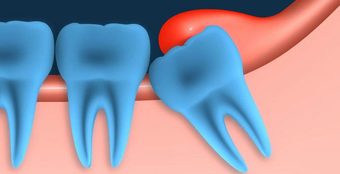 Pericoronitis