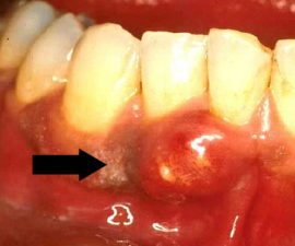 Parodontite