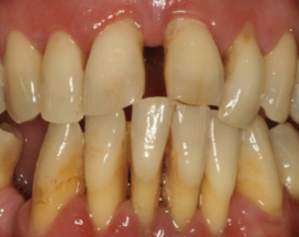 Periodontitis