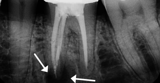 Periodontitis sa isang x-ray