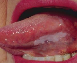 Flat dila leukoplakia