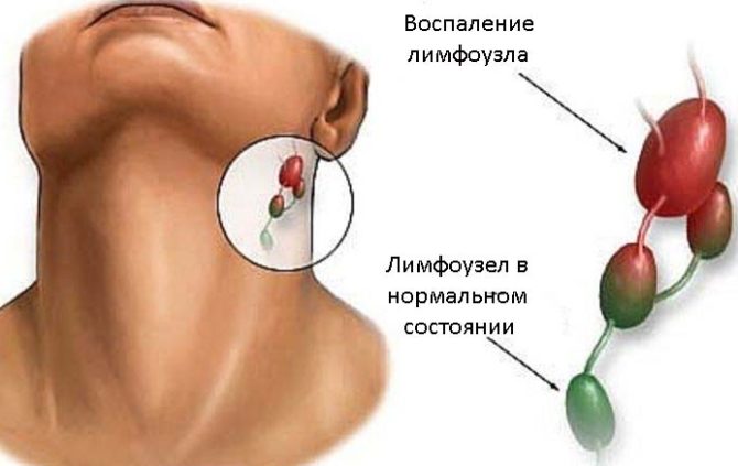 Submandibulární lymfatická uzlina v normálním a zaníceném stavu