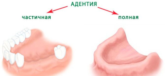 Adentia complet et partiel