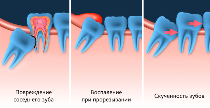 Les conséquences d'une mauvaise croissance des dents de sagesse