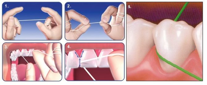 Mga Batas para sa Paggamit ng Dental Floss