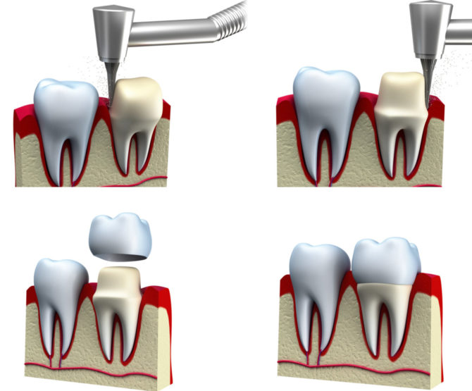 Paghahanda ng isang ngipin sa ilalim ng isang korona na korona
