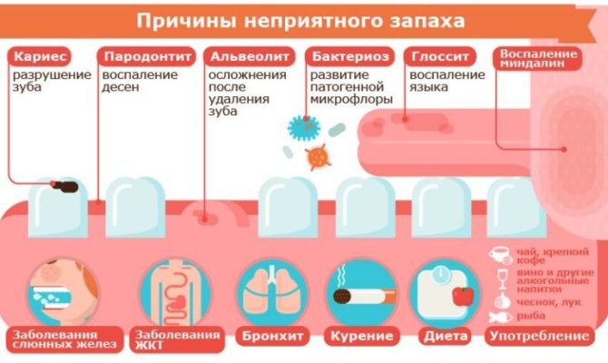 Les causes de l'halitose