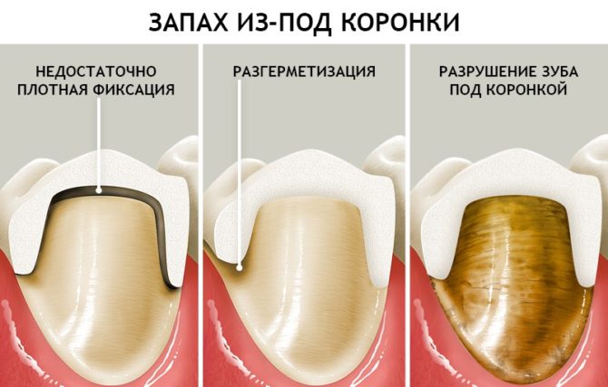 Causes de la mauvaise haleine des couronnes