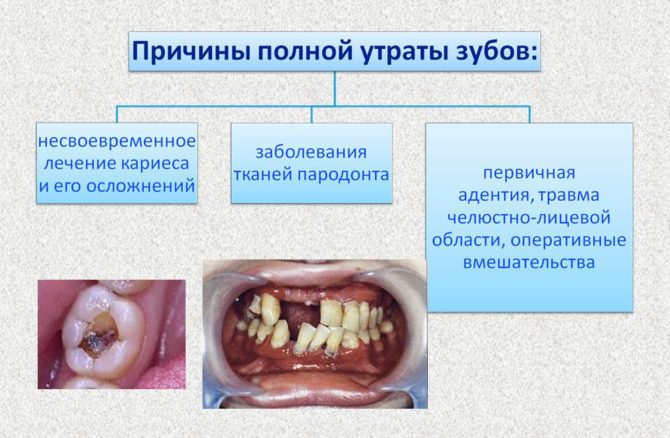 Causes de la perte complète des dents