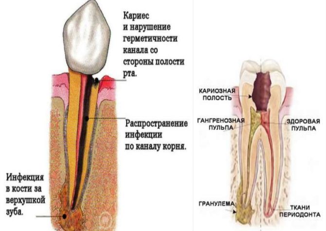 Causes du granulome