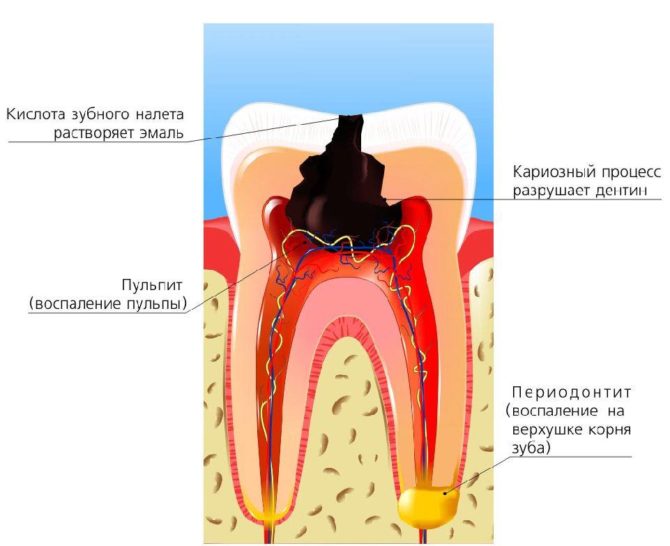 Mga Sanhi ng Toothache