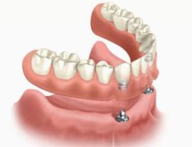 Isang halimbawa ng isang spherical attachment ng isang naaalis na prosthesis