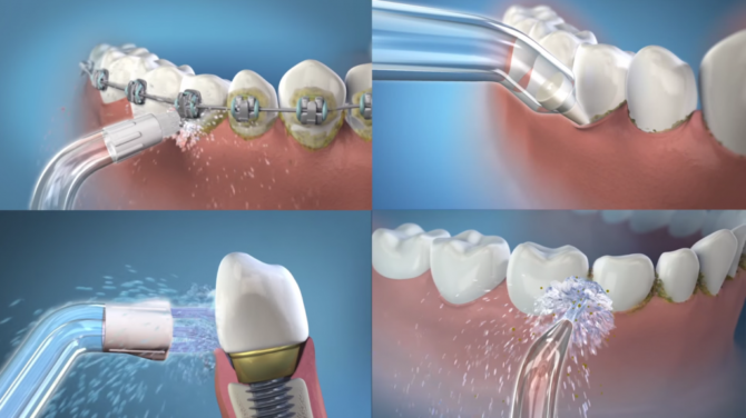 Le principe de fonctionnement de l'irrigateur Waterpik