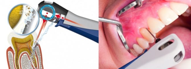 Ang prinsipyo ng pagproseso ng mga bulsa ng periodontal sa Vector ng aparato