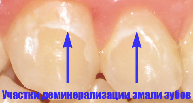 Projev demineralizace zubní skloviny