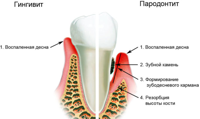 Příznaky gingivitidy a paradentózy