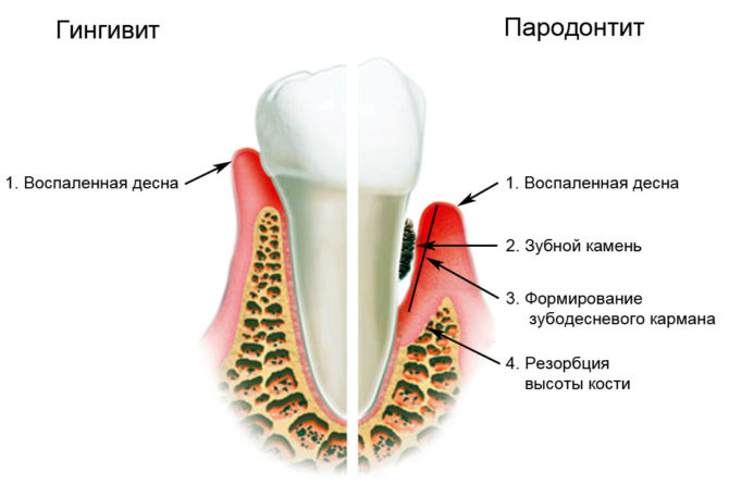 Signes de gingivite et de parodontite