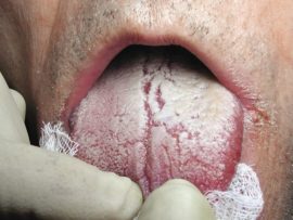 Mga palatandaan ng oral candidiasis