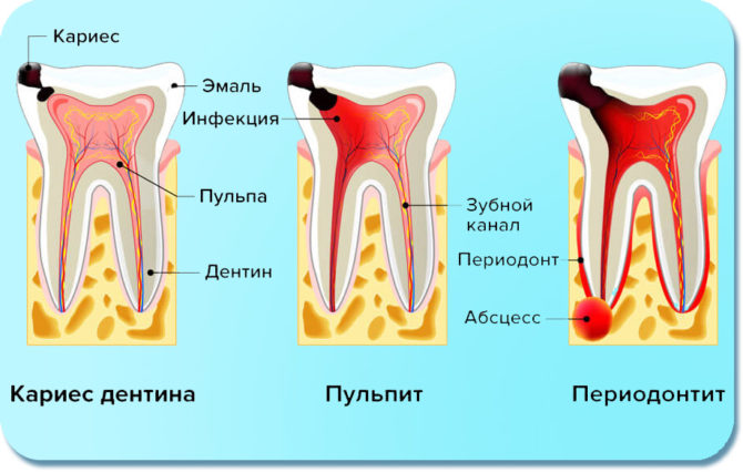 Mga palatandaan ng karies, pulpitis at periodontitis