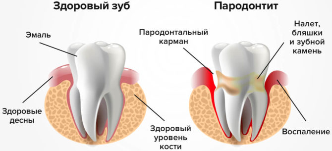 Mga Palatandaan ng Periodontitis