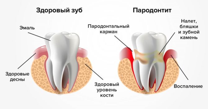 Mga Palatandaan ng Periodontitis