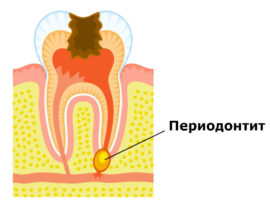 Mga palatandaan ng periodontitis