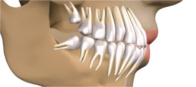 Sagesse de dentition