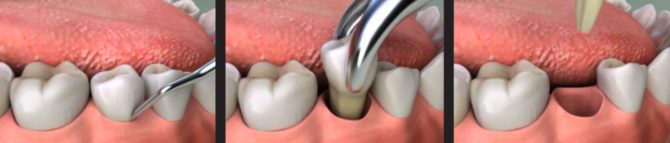 Extraction facile des dents