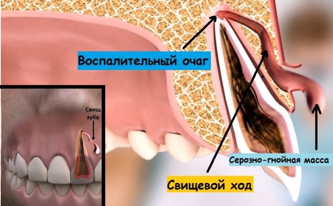 Le processus de formation d'une fistule sur la gencive