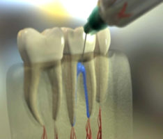 Conduction infiltration anesthesia