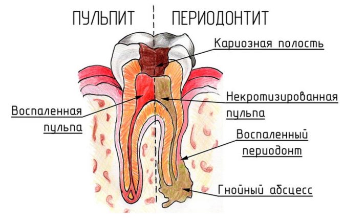 Pulpitis at periodontitis