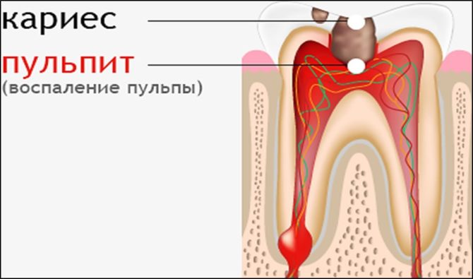 Ngipin Pulpitis