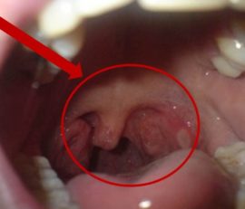 Cancer du larynx à un stade précoce