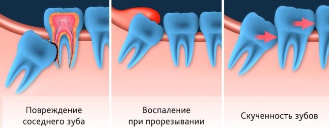 Variétés de croissance problématique des dents de sagesse